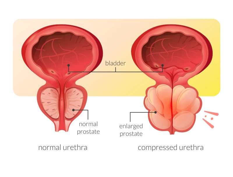 Medical illustration of prostate gland enlargement (BPH)